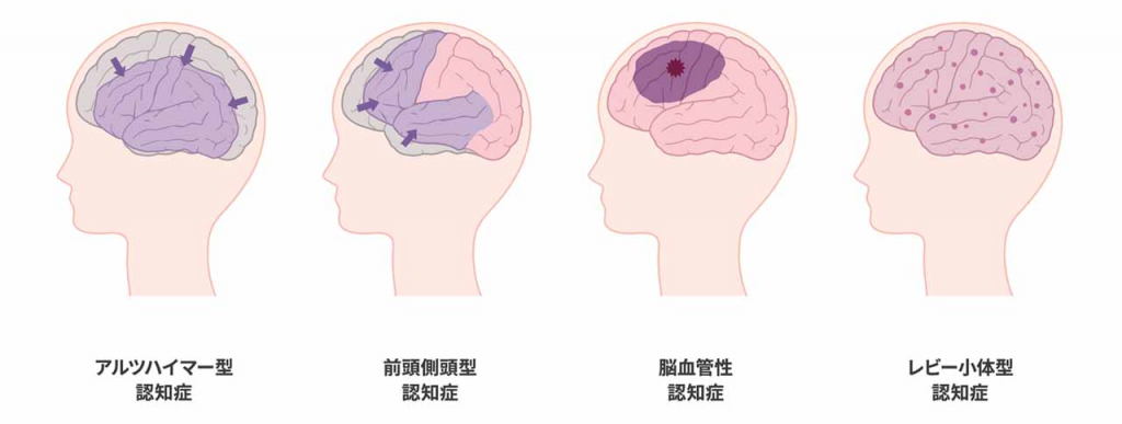 認知症の種類と主な症状・原因